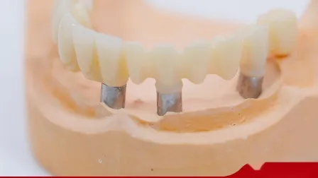 Coroa de implante dentário feita em modelos impressos em 3D